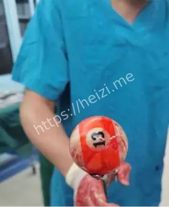直肠穿孔