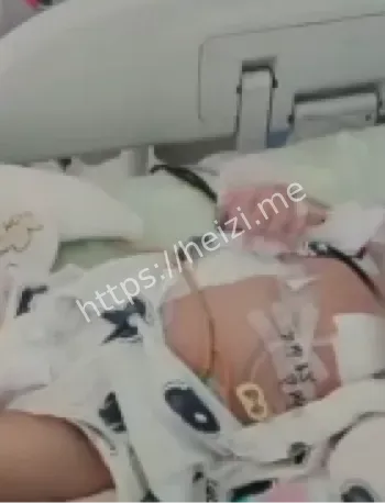 亲体肝移植