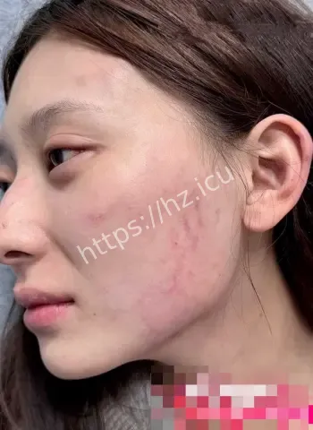 小雪回应家暴视频耳朵玄机